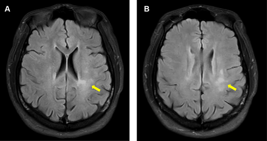 The patient’s magnetic resonance imaging (MRI) of the brain at 5 months after the seizure onset. He had no symptoms. Axial fluid-attenuated inversion recovery (FLAIR) imaging of the brain shows new poorly demarcated hyperintense lesions in the left frontoparietal white matter (arrows). Refer to the image caption for details.