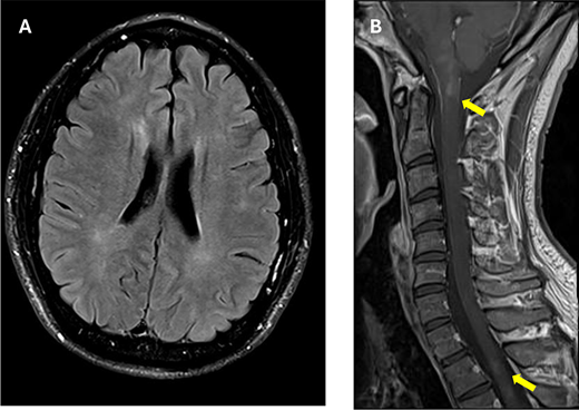 The patient’s magnetic resonance imaging (MRI) at 10 months after the seizure onset. He had intermittent paresthesia in the left leg, and his reflexes were increased in his right arm and leg. A, Axial fluid-attenuated inversion recovery (FLAIR) imaging of the brain shows ill-defined hyperintense lesions in the periventricular regions. B, Sagittal T1-weighted image of the spinal cord shows new short hyperintense lesions affecting the brainstem, the cervical spinal cord, and upper thoracic spinal cord (arrows).