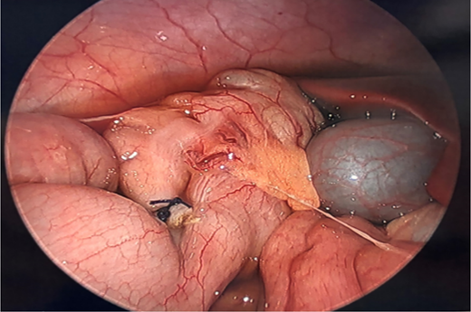Image depicting a moderate amount of serous fluid lateral to the right colon and above the liver as well as a ligated appendix base and stump. Refer to the image caption for details.