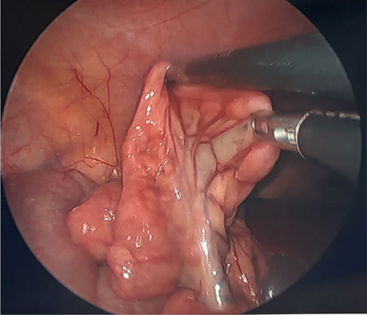 Image depicting the small bowel and its mesentery with mildly prominent lymph nodes. Refer to the image caption for details.