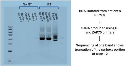 cDNA generated from RNA of the proband, his affected sister, and his affected mother confirmed aberrant splicing at Exon 12 and Exon 13 of ZAP70, consistent with the homozygous, splice-site variant found on whole-exome sequencing. Refer to the image caption for details.