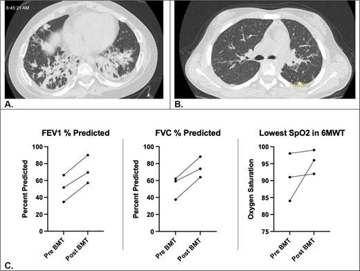 Progress of pulmonary disease pre- and post-HSCT. High-resolution CT chest images of patient #1 pre- (A) and 2.5 years post- (B) HSCT. (C) This shows percent predicted FEV1 and FVC and lowest SpO2 in 6-minute walk test for patients #1-3 (patient 4 unable to reliably perform spirometry).