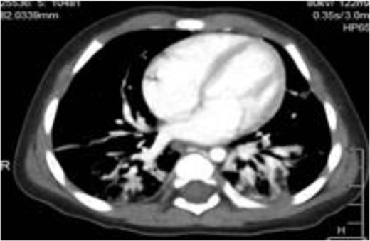 Chest CT of patient 7.