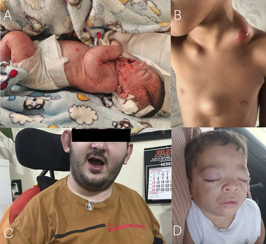 Remarkable diagnosis established by the initial analysis of the CNE3i project. A: Diffuse cutaneous pustulosis affecting a DIRA patient carrying the known homozygous c.213_227del; p.Asp72_Ile76del variant in the IL1RN gene. B: Diffuse and generalized paracoccidioidomycosis lymphadenopathy in a patient with a novel compound heterozygous variant in the DOCK8 gene (c.3209A>G; p.Asn1070Ser and c.2554G>A; p.Val852Met). C: An adult patient with a 24-year history of unexplained fever and severe neurological impairment, who carries a homozygous variant in the RNASEH2B gene (c.529G>A; p.Ala177Thr). D: Erythematous eyelash nodules in a patient with CANDLE syndrome harboring a novel homozygous mutation affecting the PSMB8 gene (c.280G>C; p.Ala94Pro).