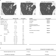 Chest CT scan and laboratory data from the patient. (A) Chest CT scanners of the patient at the start of her respiratory symptoms (left), referral to our center (middle), and 38 days after immunoglobulin replacement therapy initiation (right). (B) Laboratory data. These data were collected in 2024. The patient’s initial blood test for immunoglobulin concentration, performed in December 2023, showed a level of 3.4 g/L. LLN, lower limit of normal. (C) Total serum IgG level and anti-SARS-CoV2 spike IgG level in the patient's serum before and after immunoglobulin replacement therapy initiation. dsDNA, double-stranded DNA; ENA, extractable nuclear antigens; ANCA, anti-neutrophil cytoplasmic antibodies.
