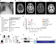 Clinical and genetic findings in a 4-year-old patient with RSV-induced fever and seizures. (A) Chest x-ray at day 1 of hospital admission showing pulmonary infiltration with fluid and atelectasis of the right upper lobe. (B) Magnetic resonance scan of the brain on day 4 after admission, showing extensive diffusion restriction predominantly involving subcortical white matter with sparing of the cortex described as “bright tree appearance.” (C) Genetic information of a novel rare variant in PARK7 leading to a premature stop codon at R28, identified by WGS. ACMG, American College of Medical Genetics; GDI, gene damaging index. (D) PopViz results showing the CADD and MAF of pLOF variants in PARK7 as identified in the patient (red) and variants reported in gnomAD, including variants leading to an early stop codon (stop gained, red), missense (grey), in-frame insertions and deletions (indel, black), start loss (yellow), alterations in mRNA splicing (splice region variant, blue), and frameshift (pink). The c.82C>T variant identified in the patient is indicated in the plot. No homozygous pLOF variants in PARK7 have been reported in gnomAD. The dashed line indicates the mutation cutoff score (MSC) at 95% confidence interval (CI). (E) Family pedigree for the PARK7 variant. The patient has two brothers whose DNA was not analyzed for the variant. (F) PARK7 RNA quantification relative to housekeeping gene (TBP) in patient PBMCs compared to healthy controls by RT-PCR. (G) PARK7 immunoblot of patient (P) fibroblast lysates compared to healthy control (C). Vinculin (VCL) was used as loading control. (H) Linear protein structure of PARK7. Amino acid (aa) residues and protein domains are indicated: the N-terminal region (light blue), DJ-1/ThiJ/Pfp I domain (dark blue), and the C-terminal region (blue). The red arrow indicates the location of PARK7 R28 that is mutated into a stop codon in the patient. DWI, diffusion-weighted imaging; ADC, apparent diffusion coefficient. Statistics were calculated using the unpaired two-tailed T test with Welch’s correction (E). **P < 0.01. Source data are available for this figure: SourceData F1.