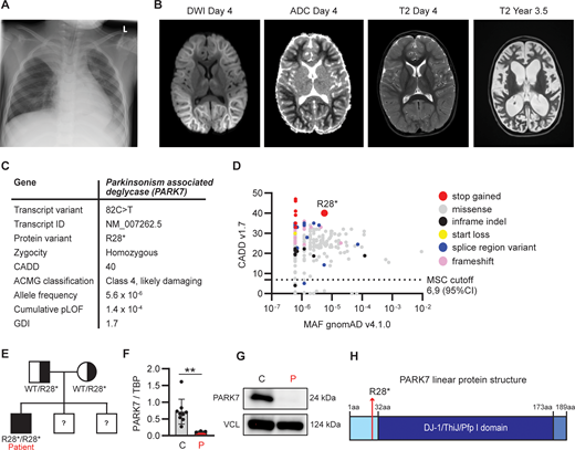 Clinical and genetic findings in a 4-year-old patient with RSV-induced fever and seizures. (A) Chest x-ray at day 1 of hospital admission showing pulmonary infiltration with fluid and atelectasis of the right upper lobe. (B) Magnetic resonance scan of the brain on day 4 after admission, showing extensive diffusion restriction predominantly involving subcortical white matter with sparing of the cortex described as “bright tree appearance.” (C) Genetic information of a novel rare variant in PARK7 leading to a premature stop codon at R28, identified by WGS. ACMG, American College of Medical Genetics; GDI, gene damaging index. (D) PopViz results showing the CADD and MAF of pLOF variants in PARK7 as identified in the patient (red) and variants reported in gnomAD, including variants leading to an early stop codon (stop gained, red), missense (grey), in-frame insertions and deletions (indel, black), start loss (yellow), alterations in mRNA splicing (splice region variant, blue), and frameshift (pink). The c.82C>T variant identified in the patient is indicated in the plot. No homozygous pLOF variants in PARK7 have been reported in gnomAD. The dashed line indicates the mutation cutoff score (MSC) at 95% confidence interval (CI). (E) Family pedigree for the PARK7 variant. The patient has two brothers whose DNA was not analyzed for the variant. (F) PARK7 RNA quantification relative to housekeeping gene (TBP) in patient PBMCs compared to healthy controls by RT-PCR. (G) PARK7 immunoblot of patient (P) fibroblast lysates compared to healthy control (C). Vinculin (VCL) was used as loading control. (H) Linear protein structure of PARK7. Amino acid (aa) residues and protein domains are indicated: the N-terminal region (light blue), DJ-1/ThiJ/Pfp I domain (dark blue), and the C-terminal region (blue). The red arrow indicates the location of PARK7 R28 that is mutated into a stop codon in the patient. DWI, diffusion-weighted imaging; ADC, apparent diffusion coefficient. Statistics were calculated using the unpaired two-tailed T test with Welch’s correction (E). **P < 0.01. Source data are available for this figure: SourceData F1. Refer to the image caption for details.