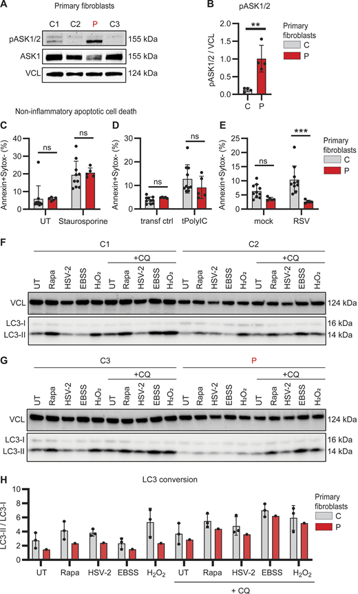 Impaired RSV-induced apoptotic cell death and reduced autophagy in patient primary fibroblasts. (A and B) Whole cell lysates from dermal fibroblasts from three controls (C, grey) and the patient (P, red) were analyzed for phosphorylation of ASK1/2 (pASK1/2), total ASK1, and vinculin (VCL) as loading control by immunoblotting (A). Graph depicting the densitometric quantification of pASK1/2 relative to total ASK1 (B). Bars show mean ± SD values of four experiments. (C–E) Primary fibroblasts from two controls (C, grey) and the patient (P, red) were stained with Annexin-V (apoptosis) and SYTOX Green (viability dye) to analyze induction of noninflammatory apoptotic cell death by flow cytometry. Cells were left untreated (UT) or treated with staurosporine (1 mM, 4 h) (C), mock transfected (transf ctrl) or transfected with PolyIC (tPolyIC, 500 ng/ml, 24 h) (D), or infected with mock virus (mock) or RSV (RSV-A strain Long, MOI 3, 24 h) (E). Bars show mean ± SD values of two experiments performed in duplicate and triplicate. (F–H) Primary fibroblast from three controls (C1–3) and the patient (P) were left untreated (UT), stimulated with rapamycin (Rapa, 500 nM, 24 h), HSV-2 (MS strain, MOI 1, 24 h), starved by culture in EBSS (4 h) or stimulated with H2O2 (300 nM, 30 min), in the absence or presence of chloroquine (+CQ, 20 μM, 4 h) to evaluate autophagy flux. Whole cell lysates were analyzed by immunoblot for LC3 lipidation and conversion of LC3-I into the smaller LC3-II with VCL as loading control. (H) Graph showing the ratio LC3-II/LC3-I as indicator for autophagy induction in primary fibroblasts from three controls (C, grey bars) and the patient (P, red). The ratio of LCR3-II/LC3-I was quantified using densitometry analysis of immunoblots in F and G. Bars show mean ± SD values. Statistics were calculated using the unpaired T test (B) and ordinary two-way ANOVA with Šídák’s multiple comparisons (C–E). ** = P < 0.01, *** = P < 0.001, and ns = not significant. SD, standard deviation. Source data are available for this figure: SourceData F3. Refer to the image caption for details.