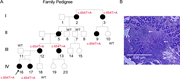 CTLA-4 Y218* mutation in four generations of a family. (A) Pedigree of the affected family, with proband identified by the arrow (patient 16); filled symbols signify clinically affected family members, with the heterozygous CTLA4 c.654T>A, p.(Tyr218*) variant noted in individuals who harbor it. WT denotes family members sequenced and found to have no mutation. Squares represent males, and circles represent females; a diagonal line (as in family member 5) indicates a deceased individual. (B) Biopsy of the terminal ileum from P12 showing diffuse lymphocytic infiltrates (arrows).