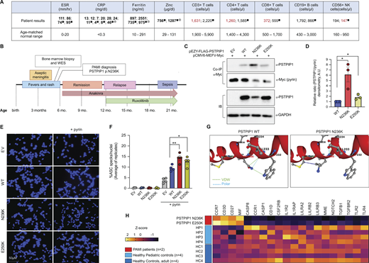 Identification and functional characterization of PSTPIP1 mutation N236K in a patient with PAMI syndrome. (A) Laboratory testing results for markers of inflammation and for leukocyte subset frequencies. Results were obtained on at least two occasions for erythrocyte sedimentation rate (ESR), C-reactive protein (CRP), ferritin, and zinc, and the indicated leukocyte subsets. Repeated measures obtained on separate dates are separated by semicolons. Values above the age-matched normal range are bolded. Values below the normal range are in red font. Data were obtained while the patient was between 5 and 22 mo of age. ■measurement taken while on anakinra; ⊕while on ruxolitinib. NK, natural killer. (B) Timeline of patient’s clinical course. WES, whole-exome sequencing. (C) Co-immunoprecipitation (co-IP) experiments assessing the ability of WT and mutant forms of PSTPIP1 (pEZY-FLAG-PSTPIP1) to bind pyrin (pCMV6-MEFV-Myc). EV, empty vector control; IB, immunoblot. (D) Quantitation of PSTPIP1 protein, relative to pyrin protein, in co-IP samples from three independent experiments performed as in B. *P < 0.05, paired two-tailed T test. (E) ASC speck assays using HEK293-ASCYFP cells transfected with pEZY-FLAG-PSTPIP1 plasmids (EV, WT, N236K, or E250K), with or without pyrin (pCMV6-MEFV-Myc). ASC is visualized in green, and DAPI-stained nuclei are visualized in blue. (F) Quantitation of ASC specs, normalized to DAPI-stained nuclei, from fluorescence microscopy images using automated counting in ImageJ. Each data point is the average of at least 10 fields per condition in a single experiment. Graph shows results from n = 4 independent experiments. *P < 0.05, **P < 0.01, paired two-tailed T test. (G) A partial crystal structure of WT PSTPIP1 surrounding the N236 residue is shown, from Protein Data Bank entry 7AAN. The N236 amino acid is polar and undergoes Van der Waals interactions (VDW) with neighboring amino acids. Modeling of the N236K mutation shows loss of VDW interactions and polarity. (H) Patterns of gene expression in whole blood samples from PAMI patients (n = 2), healthy pediatric controls (HP, n = 4), and healthy adult controls (HC, n = 4). All genes included on heatmap showed P < 0.05 in comparisons of patients vs. healthy adult controls and patients vs. healthy pediatric controls, and P > 0.05 in comparisons of healthy adult controls vs. healthy pediatric controls (two-tailed unpaired T test). Source data are available for this figure: SourceData F1.