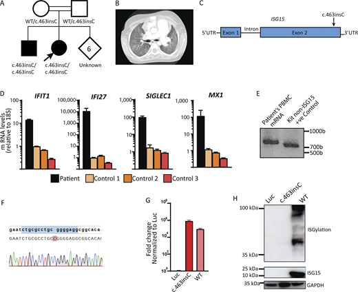 Identification of a patient with a novel ISG15 mutation. (A) Family includes two affected children carrying a homozygous variant (c.463insC) on ISG15 and six children of unknown status. The arrow indicates the patient described in this section (proband). (B) CT of the younger sibling taken at age 12. Extensive diffuse ground-glass opacities with subpleural sparing and enlargement of the main pulmonary artery are observed. (C) Schematic localization of the ISG15 variant in the genomic DNA locus indicated by the arrow. (D) Expression levels of various ISGs (IFI27, MX1, SIGLEC1, and IFIT1) were assessed from patient’s whole blood, as well as from the three healthy controls. Target genes were normalized on 18S rRNA expression. (E) 3′-RACE PCR targeting ISG15 was performed on RNA isolated from patient’s whole blood. (F) Sanger sequencing of the 3′-RACE band from E. (G) HEK293T cells were transfected with a plasmid encoding the ISG15 variant (c.463insC), ISG15 WT, or Luc. Relative mRNA levels for ISG15 were assessed by qRT-PCR, performed twice for each variant, with technical triplicates; the data from one representative experiment (n = 3) are shown. The expression level of ISG15 was normalized to GAPDH. (H) HEK293T cells were transfected with a plasmid encoding the ISG15 variant (c.463insC), ISG15 WT or Luc, plus HERC5, UBE1L, and UBCH8, as described in (23). Cell lysates were analyzed by western blotting for ISG15 and ISGylation; a representative experiment is shown. CT, chest tomography. Source data are available for this figure: SourceData F1. Refer to the image caption for details.