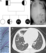 An image contains a pedigree chart, an X-ray, a growth chart, and a CT scan, illustrating clinical findings in two children with a NCKAP1L mutation.