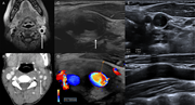 Medical imaging of the head and neck showing carotid artery inflammation at diagnosis and after treatment.