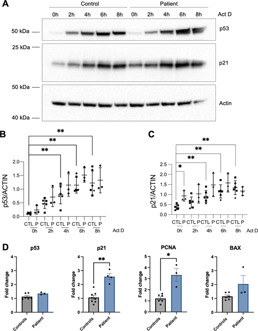 A multi-panel image depicting the expression of p53 and p21 proteins in control and patient samples treated with actinomycin D over different time points.