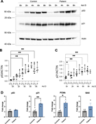 A multi-panel image depicting the expression of p53 and p21 proteins in control and patient samples treated with actinomycin D over different time points.