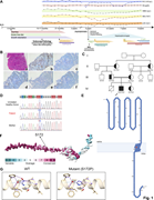 A multi-panel image shows a patient's clinical history, genetic analysis, and structural characterization of a genetic variant.