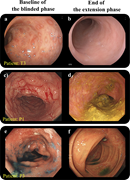 Colonoscopy images showing before and after treatment for three patients.