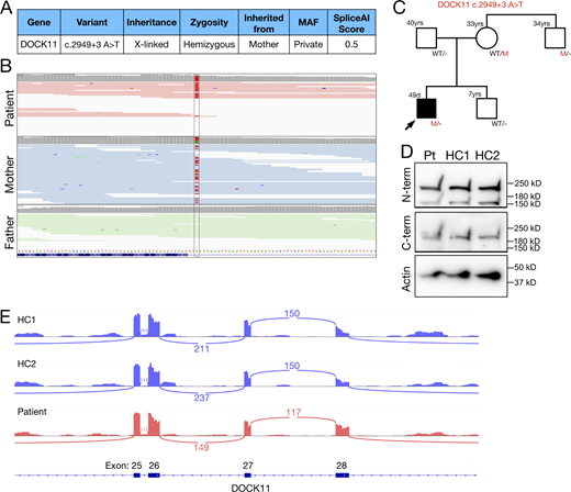 A multi-panel image showing genetic analysis and protein expression related to a DOCK11 variant.