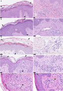 A multi-panel image showing cross-sectional microscopy images of skin biopsies with various histological features.