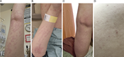 Examples of clinical skin lesions from case 16